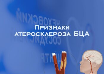 🔌 Признаки атеросклероза БЦА